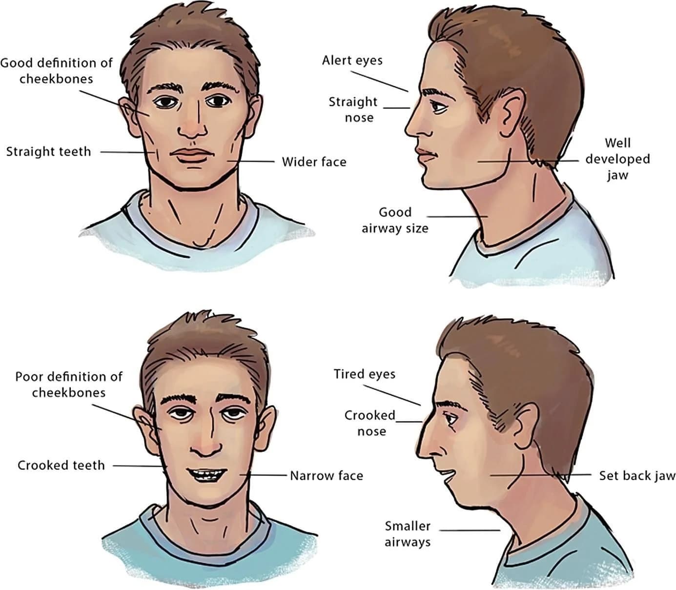 Faces compared: good cheekbones, straight teeth and a well-developed jaw, against a narrow face, crooked teeth and a set-back jaw