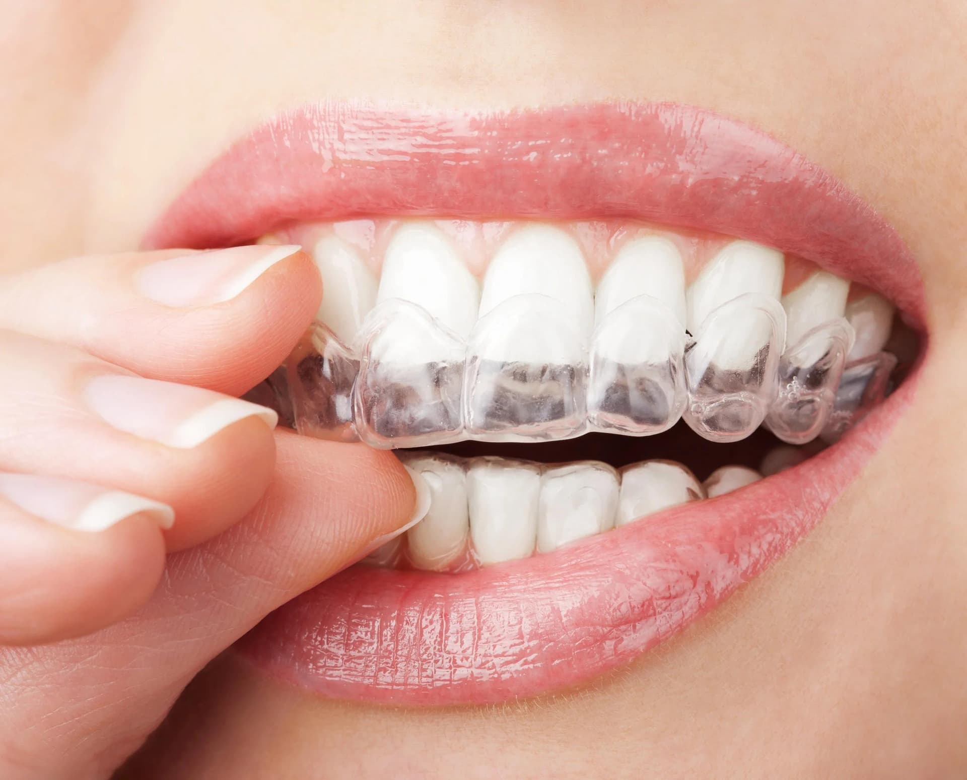 Fitting a clear aligner over the teeth