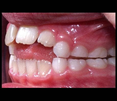 A tongue pushing forward between the front teeth